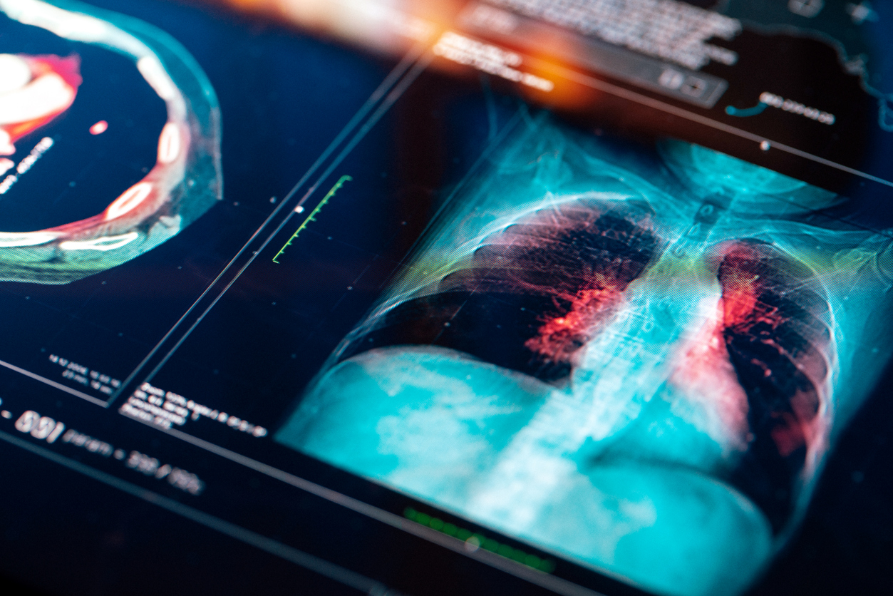 All the treatment options for lung cancer | SingHealth