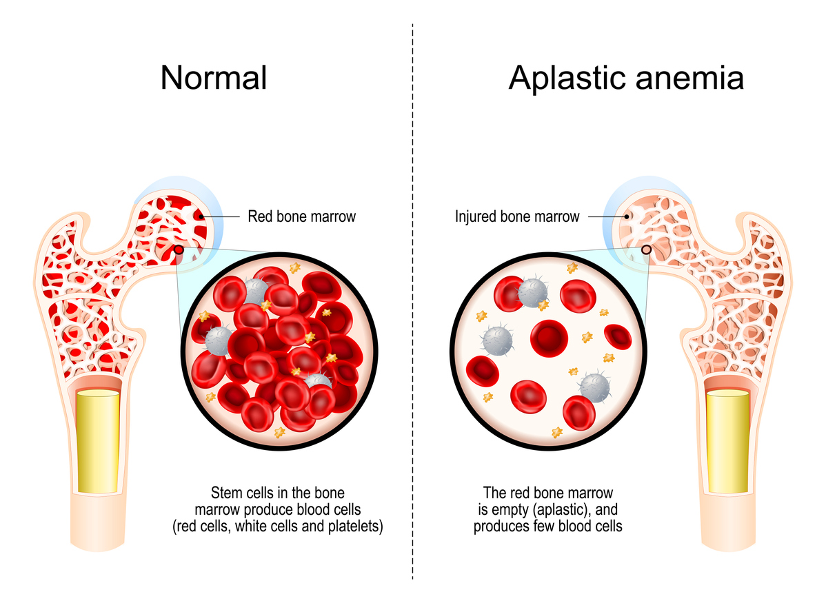comparison of the blood between someone with normal condition and someone with aplastic anaemia
