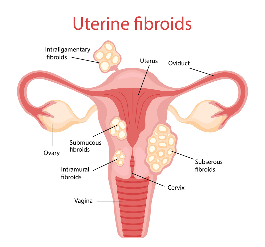 uterus with uterine fibroids