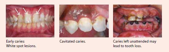 Caries or tooth decay - National Dental Centre Singapore