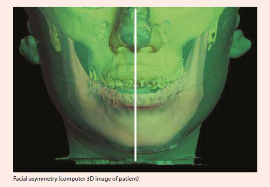 jaw malalignment surgery