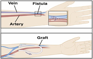 Dialysis Procedure Treatment