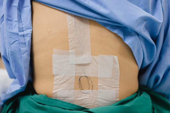 Epidural