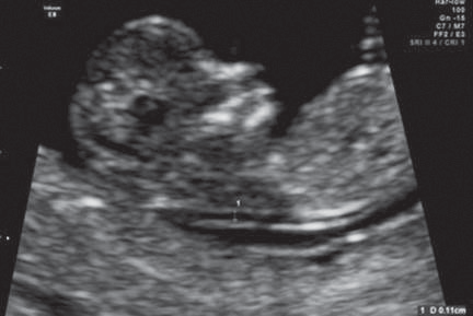 Figure 2. Nuchal translucency (seen between the two white + markings) of the fetus.