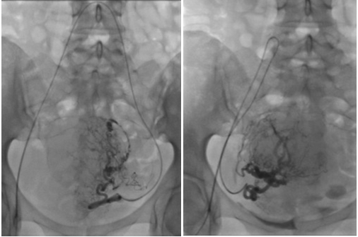 Uterine Fibroids