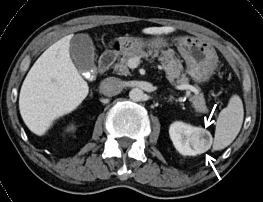 Renal Ablation