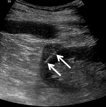 Renal Ablation