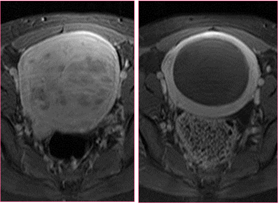 Uterine Fibroids