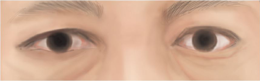 Eye bags treated with aesthetic eyelid surgery (blepharoplasty)