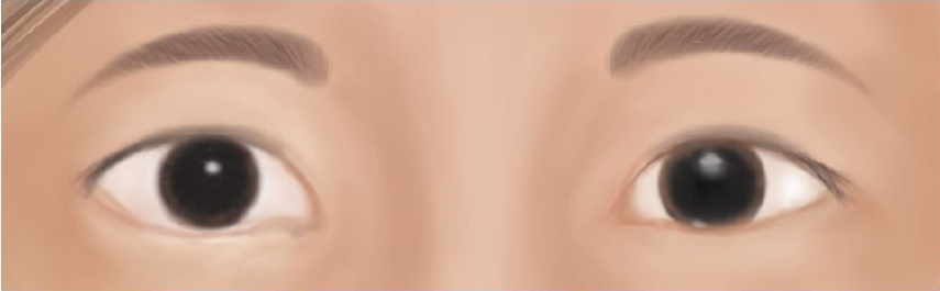 Droopy upper eyelid skin treated with aesthetic eyelid surgery (blepharoplasty)