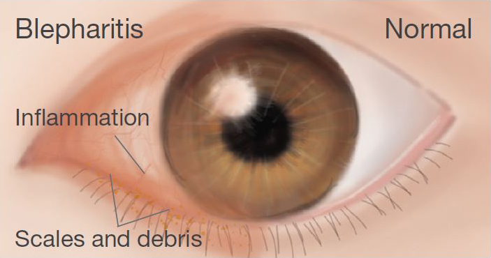 Blepharitis eye condition - SinghHealth