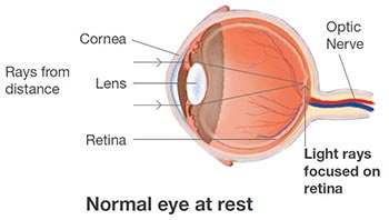 childhood myopia conditions & treatments