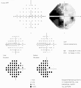 optic neuritis swollen right visual field