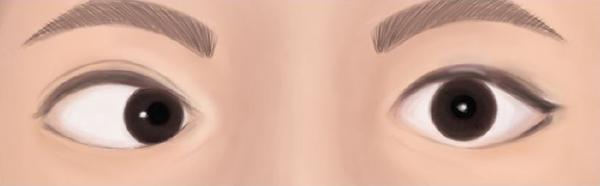 Inward drifting of the right eye (Convergent squint)