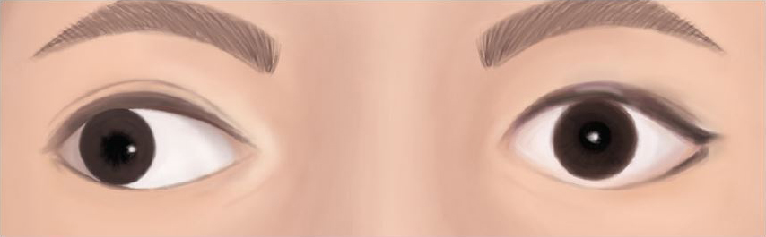 Outward drifting of the right eye (Divergent squint)