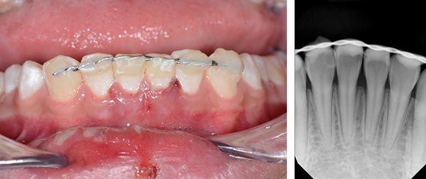 splinting of lower teeth after avulsion