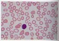 Signs of anaemia