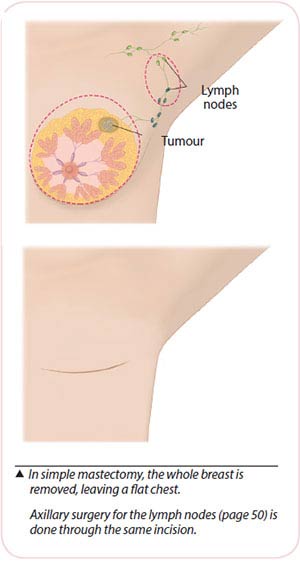 mastectomy for breast cancer