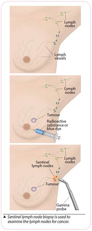 breast cancer treatment - sentinel lymph node biopsy (SLNB)