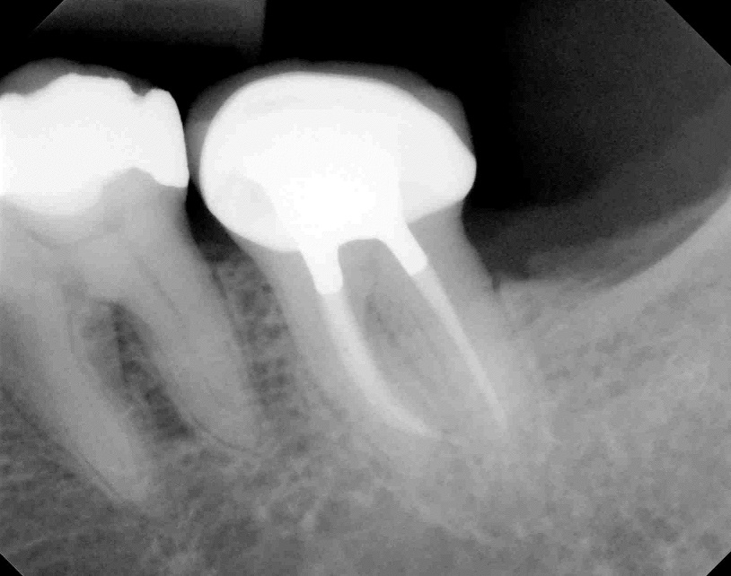 Gutta-percha root filling with permanent restoration by the National Dental Centre Singapore