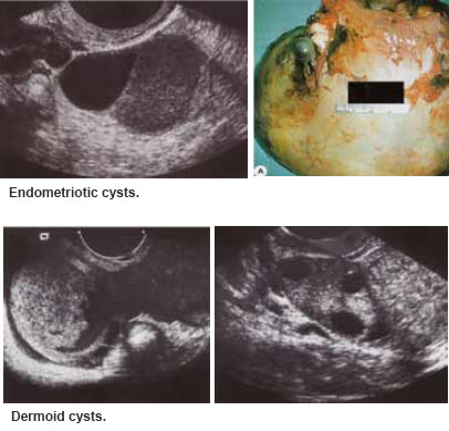 Endometriotic and dermoid cysts are benign ovarian cysts - SGH.