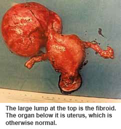  uterus with a uterine fibroids