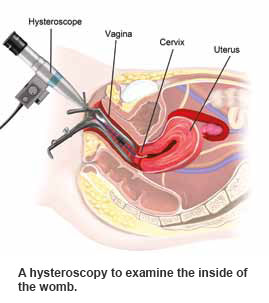Menorrhagia hysteroscopy - condition and treatment SingHealth