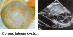 Corpus luteum cysts is one type of ovarian cysts - SGH.