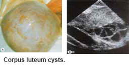 corpus luteum ovarian cysts