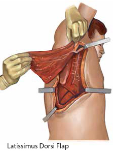 Latissimus Dorsi Flap - SingHealth Duke-NUS Head and Neck Centre