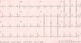 An example of an ECG recording - KKH