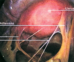 endometriosis inflammation and adhesions