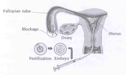 IVF embryo transfer at KKH