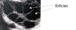 IVF transvaginal ultrasound scan at KKH