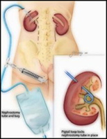 Nephrostomy at KKH