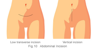 Ovarian cancer treatment - abdominal incision at KKH