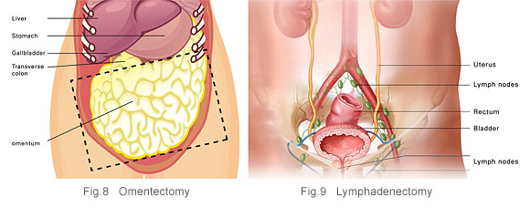 Ovarian cancer treatment - omentectomy - lymphadenectomy at KKH