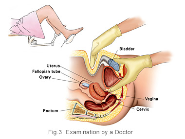 Ovarian cancer diagnosis examination by a doctor KKH