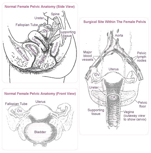 Radical hysterectomy at KKH