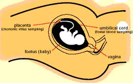 Fetal blood sampling for thalassaemia at KKH