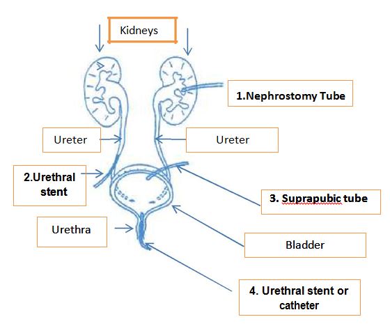 Caring of urinary drainage tubes or catheters - KKH