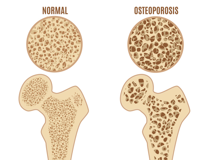 Osteoporosis - SingHealth