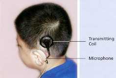 A child wearing the device with labeled components for sound transmission | SingHealth