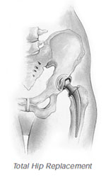 Hip Surgery Singapore General Hospital