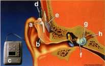A cochlear implant inside the ear and its internal structure and function  | SingHealth