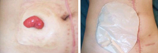 Stoma in stomach | SingHealth