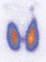Thyroid Scan Singapore General Hospital