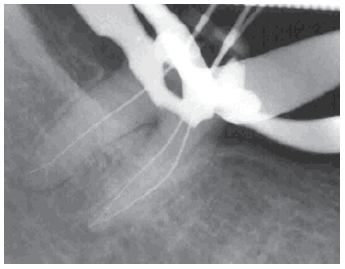 X-ray showing files in root canal, according to the National Dental Centre Singapore