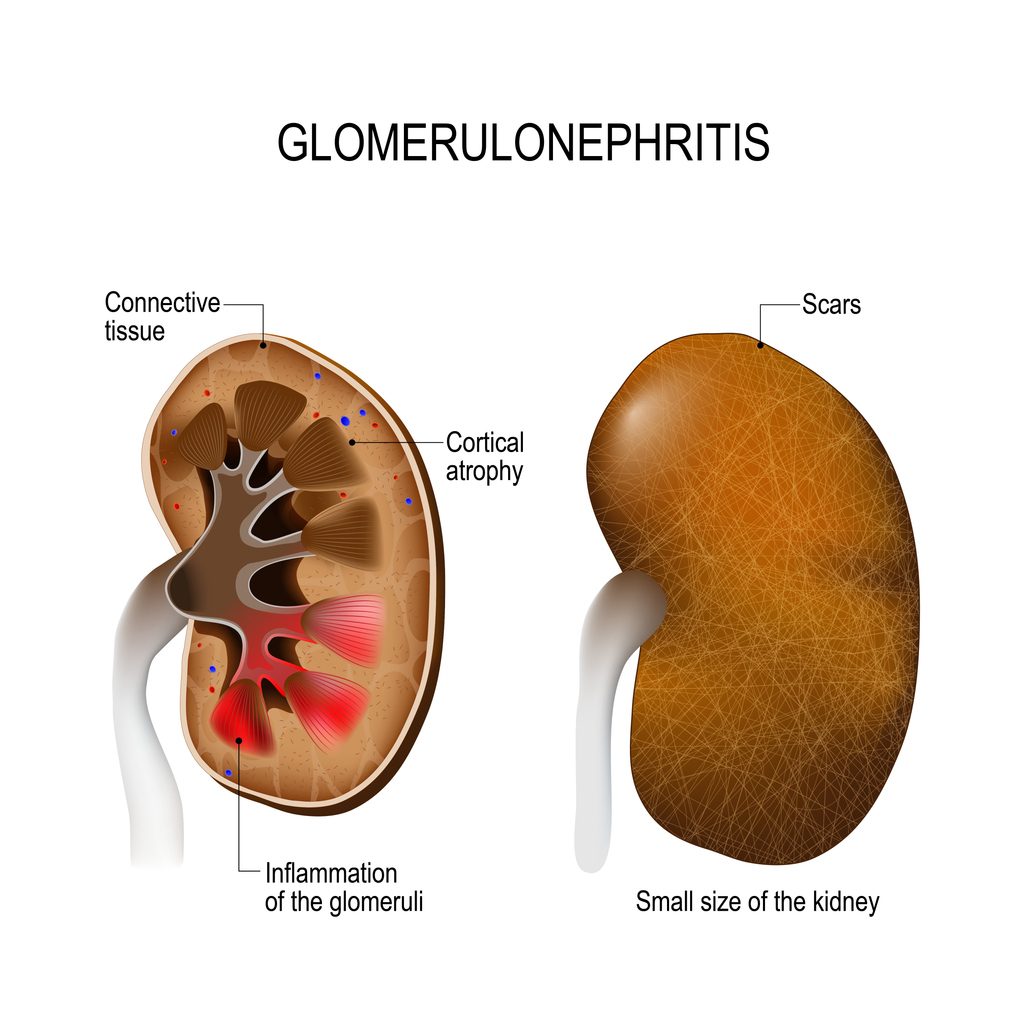 kidney with glomerulonephritis