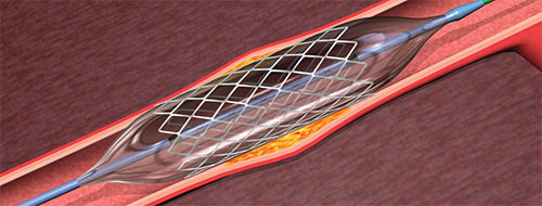 Treatment for coronary artery disease | SingHealth